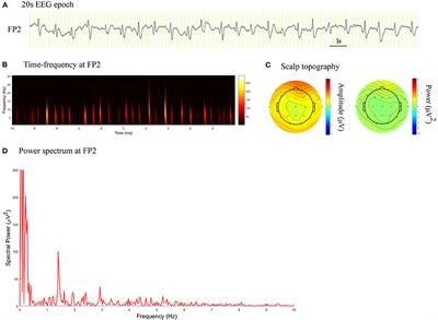 Can Spectral Power Be Used as a Candidate Seizure Marker of the Periodic Discharges Pattern?